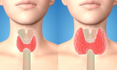 thyroid-symptoms