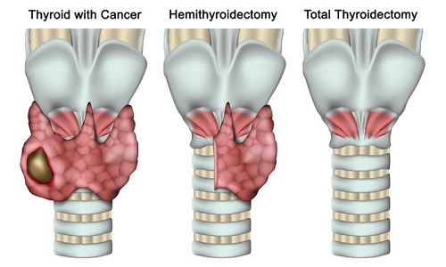 treatment-thyroid-thyroidectomy-surgery